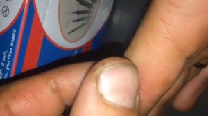 Водянная мозоль что делать?