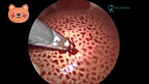 Лимфома печени у кота. Биопсия. Холецистоцентез / Liver lymphoma. Byopsy. Cholecystocentesis.