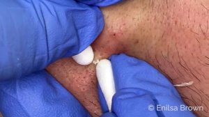 Blackhead & Whitehead Extractions on "K" - Part 2