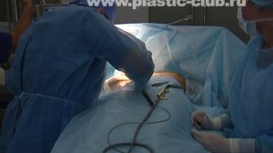 Увеличение груди. Пластический хирург Максим Осин