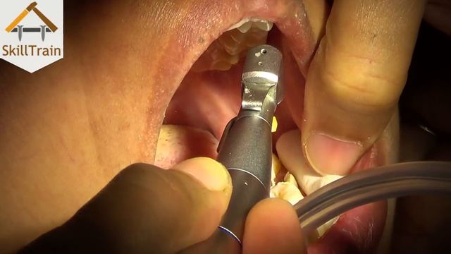 Root Canal Filling (Marathi) (मराठी) смотреть онлайн