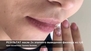 Лидаза. Удаление филлера из губ.