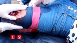 ПМП при переломах