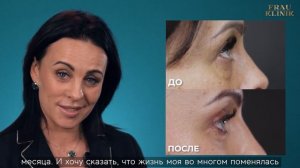 Отзыв. Нижняя блефаропластика. Хирург Козлов В. В.