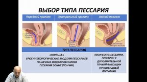 Пессарии в гинекологической практике. Возможности и ограничения