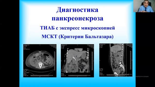 Острый панкреатит.