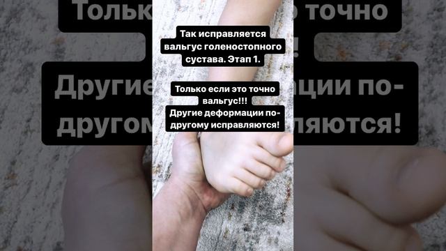 Вальгус Плосковальгусная деформация