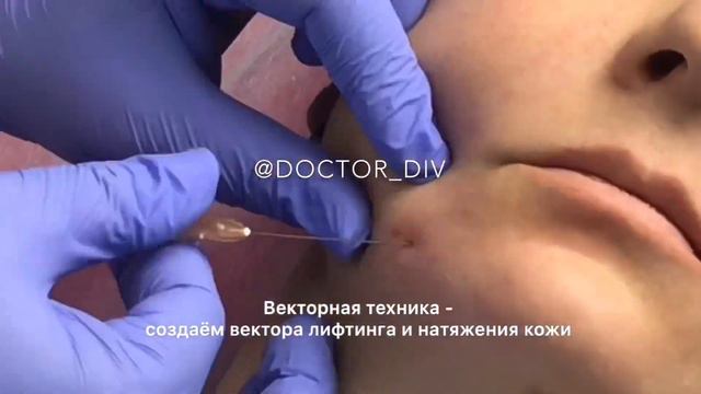 Коррекция носогубных складок и морщин марионеток