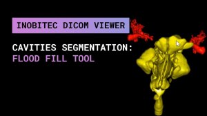 Сегментация полостей с помощью инструмента заполнения полостей в Inobitec DICOM Viewer Pro