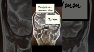 MRI brain. Meningioma - cavernous sinus. Менингиома.