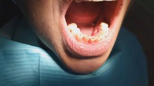 Цельнолитой мостовидный протез с пластм. облицовками и мк. коронки. 4-я стоматология. 04.07.2023.