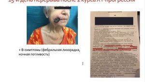Горенкова Л.М. Принципы терапии нодальных и кожных Т-клеточных лимфом.