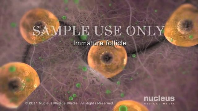 Polycystic Ovary Syndrome | PCOS | Nucleus Health смотреть онлайн