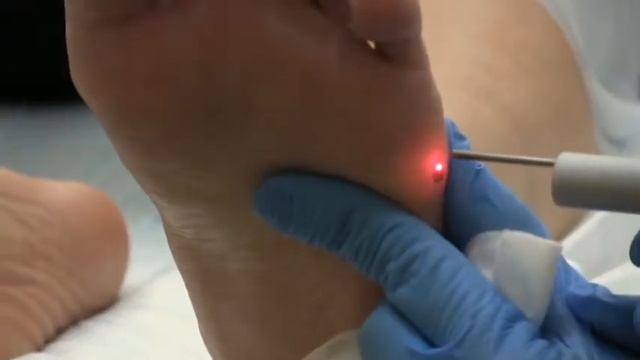 Удаление подошвенных бородавок лазером смотреть онлайн