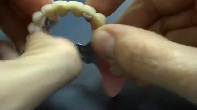 Бюгельный протез на ригельных замках