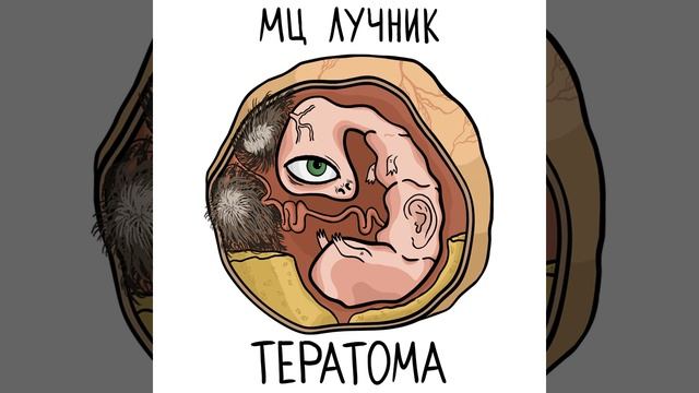 Тератома