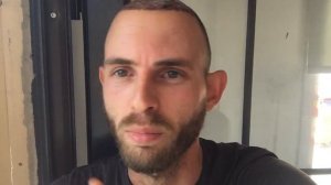 Четвертый день после пересадки волос