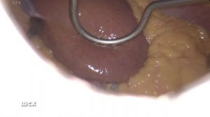 Зачем нужен ретрактор Натансона?