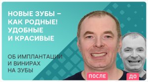 Улыбка, которой хочется гордиться! Имплантация и виниры на зубы