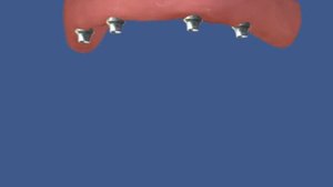 11  Съемный протез на имплантатах на балочной фиксации, верхняя челюсть