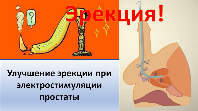 Улучшение эрекции при электротимуляции простаты