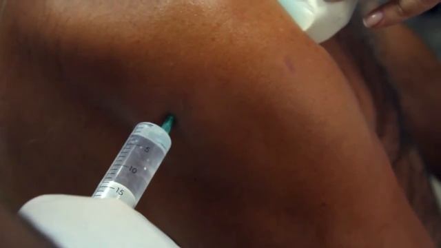 Укол в плечо. Задний доступ. Дистензионнная инъекция. Адгезивный капсулит смотреть онлайн