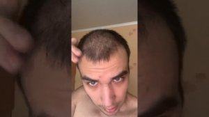 Результат пересадки волос 93-й день, 5100 графтов