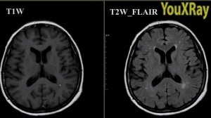 Базовые лекции по МРТ / МР-последовательности: разница между T1W и T2W FLAIR изображениями