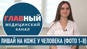 Как выглядит ЛИШАЙ у человека (фото 1-8). Стригущий лишай на коже. Микроспория у детей и взрослых