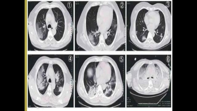 Гострі пневмонії у дітей смотреть онлайн