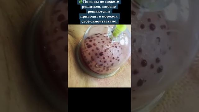 хиджама, кровопускание, баночный массаж, гирудотерапия .