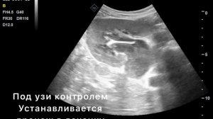 Пионефроз слева , Перкутанная нефростомия