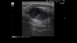 Метастаз в лимфоузел шей, пример 2