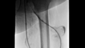 Артериовенозная фистула