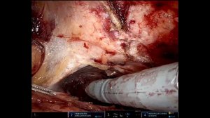 eTEP RS for recurrent M3W2