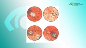 Что такое токсоплазмоз?