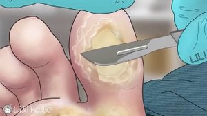 Satisfying! foot wart treatment | screw nail removal | tingle sound