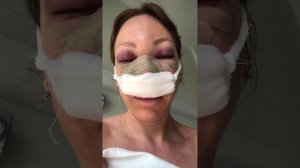 Ринопластика делать или нет ? Мой опыт #ринопластика #ринопластикамосква #нос