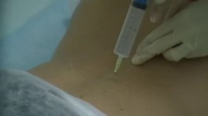 Процедура обкалывания озоном поясничного отдела позвоночника
