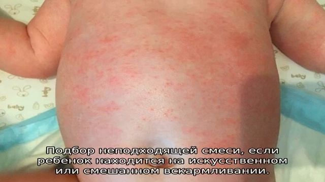 Жидкий стул у грудничка на грудном вскармливании