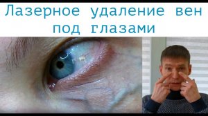 Вены под глазами / Разговор с флебологом / Удаление лазером