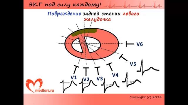 ЭКГ при различных локализациях инфаркта миокарда