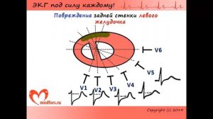 ЭКГ при различных локализациях инфаркта миокарда