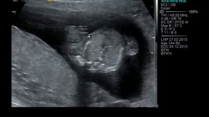 Узи 15 недель