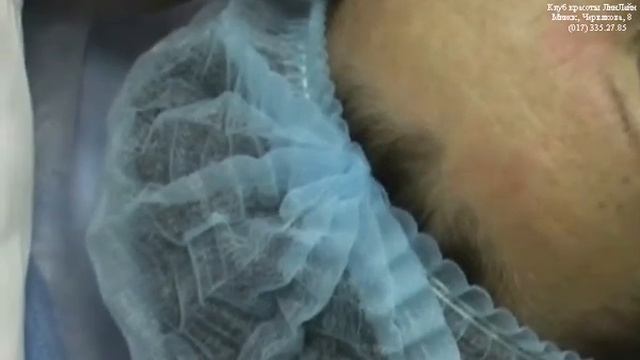 Фракционное лазерное омоложение смотреть онлайн