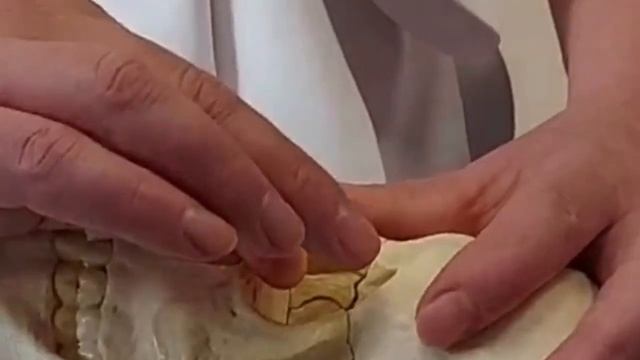 Алгоритм Молодости фрагмент семинара скуловая кость глазница