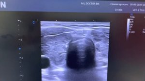 УЗИ Щитовидной железы. Эхокартина диффузно- токсического зоба.