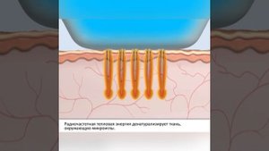 Микроигольчатый рф лифтинг