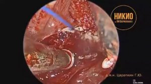 Удаление миндалин лазером Wolf TruBlue