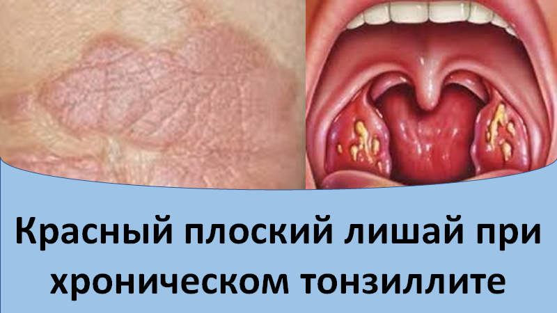 Красный плоский лишай при хроническом тонзиллите